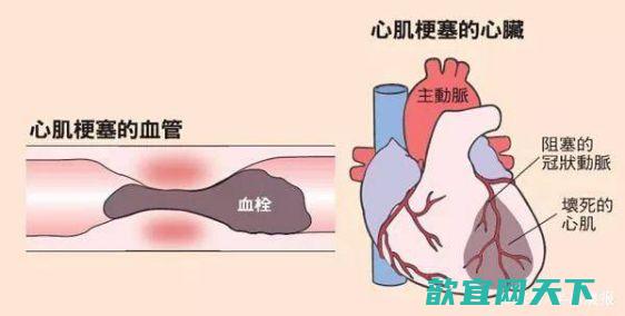 心肌梗塞的就地抢救方法